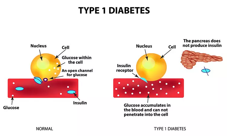 10 Things to Know About Type 1 Diabetes