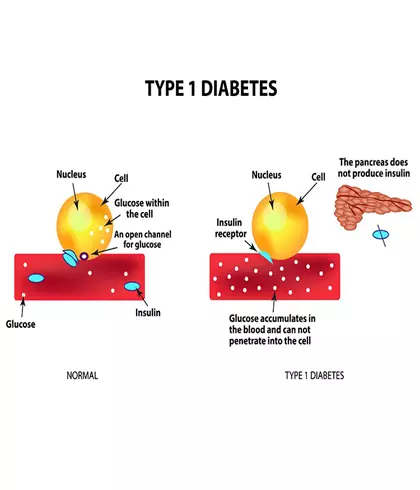 10 Things to Know About Type 1 Diabetes