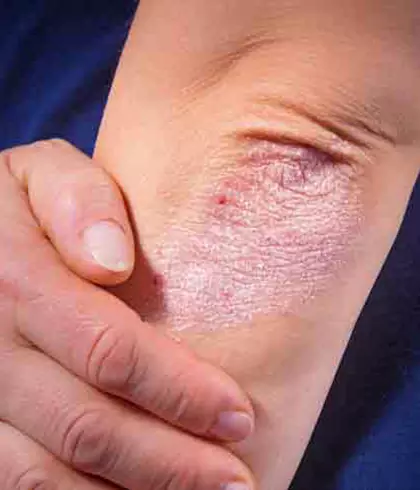  7 Psoriasis Triggers to Avoid