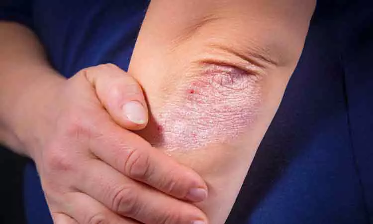  7 Psoriasis Triggers to Avoid