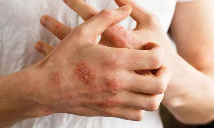 DOES ECZEMA FLARE UP IN SUMMER CONTROL IT