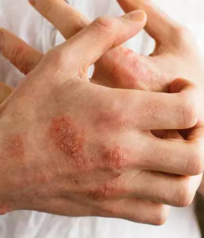 DOES ECZEMA FLARE UP IN SUMMER CONTROL IT