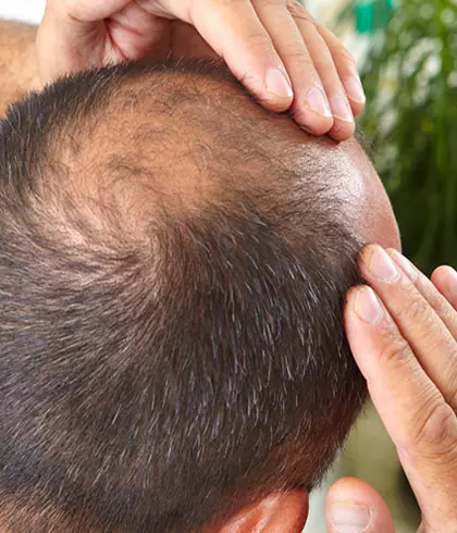 Factors responsible for causing Alopecia Areata