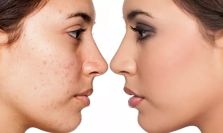 Get rid of pimples the natural way