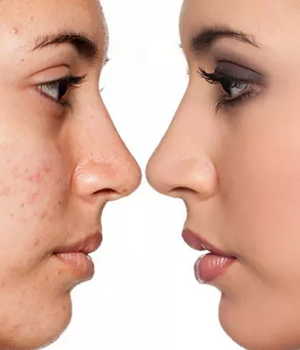 Get rid of pimples the natural way
