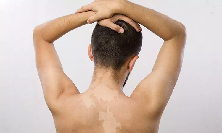 Get rid of white patches with the help of homeopathy…