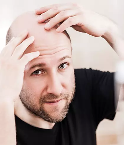 Hair loss runs in my family. Is there any way I can prevent it?
