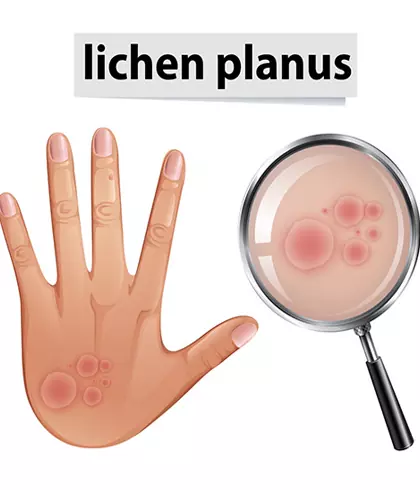 HEAL YOUR LICHEN PLANUS SYMPTOMS WITH HOMEOPATHY