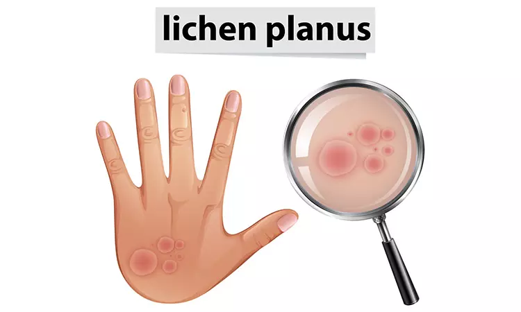 HEAL YOUR LICHEN PLANUS SYMPTOMS WITH HOMEOPATHY