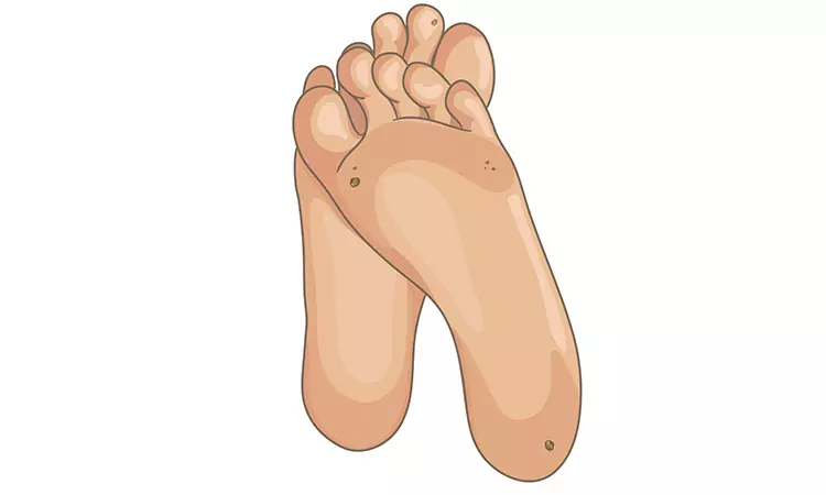 Homeopathic Treatment for Warts Removal