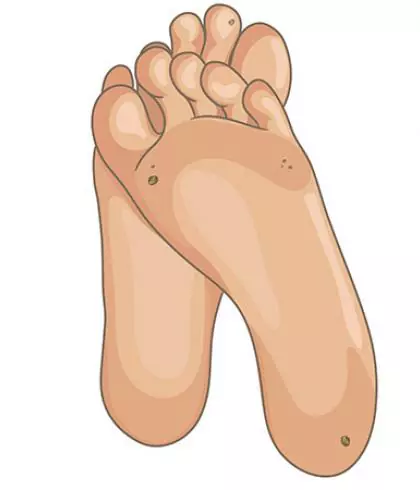 Homeopathic Treatment for Warts Removal