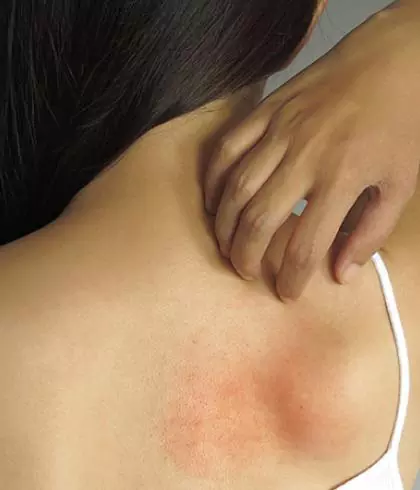 How to stop Psoriasis from Spreading?