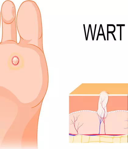 How to tell if it’s a wart?