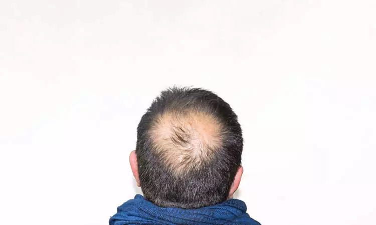 Losing hair in patches could be an autoimmune disorder. Check with your doctor now.