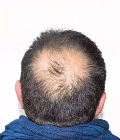 Losing hair in patches could be an autoimmune disorder. Check with your doctor now.