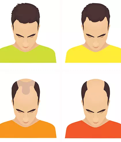 The best ways to combat a receding hairline