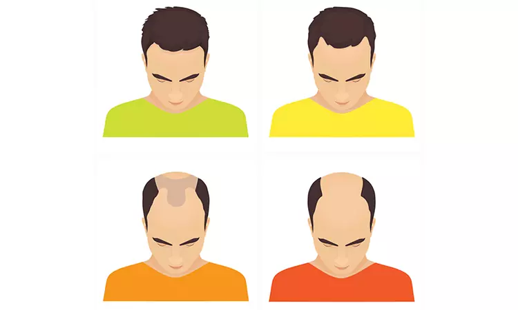 The best ways to combat a receding hairline
