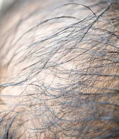 Understanding and combating Telogen Effluvium Hair Loss
