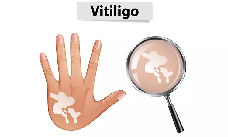Vitiligo… when skin loses its pigmentation