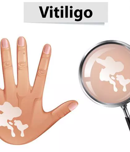 Vitiligo… when skin loses its pigmentation