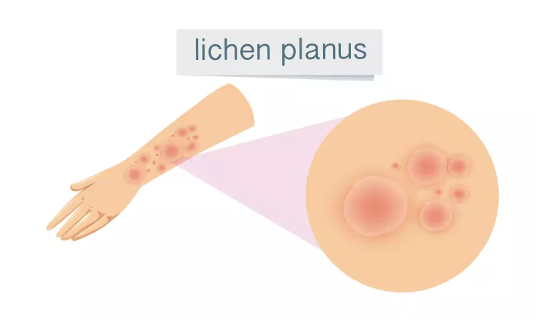 What is Lichen Planus?