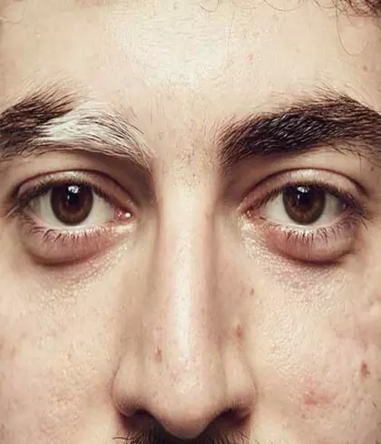 All that you wanted to know about Vitiligo