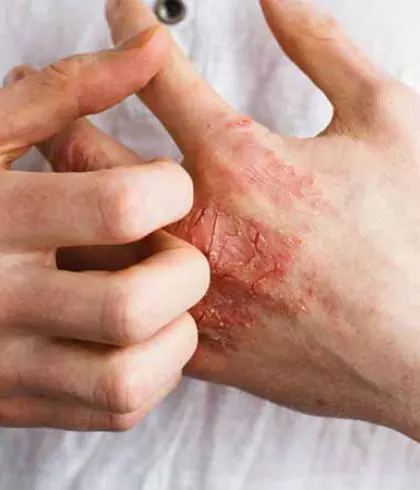 CAN ALLERGIES WORSEN ECZEMA