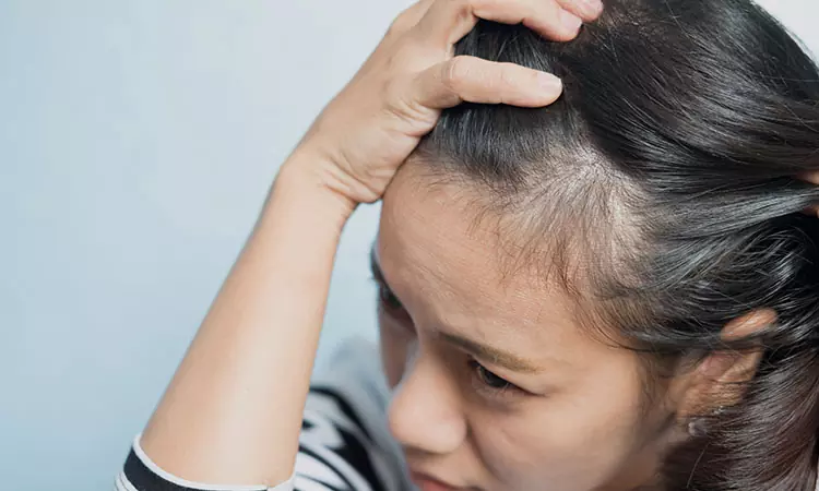 Can alopecia areata affect women