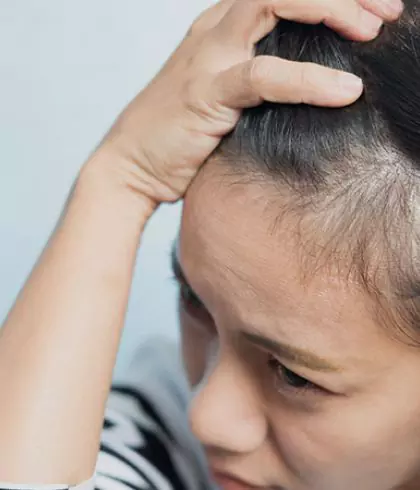 Can alopecia areata affect women