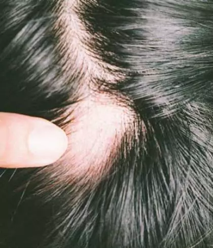 Can alopecia areata be treated?