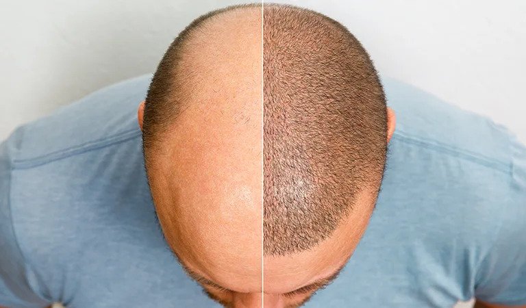 What are the early symptoms of baldness?