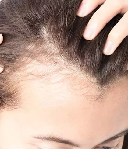 How to prevent thinning hair