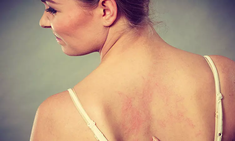 How to treat and get rid of hives