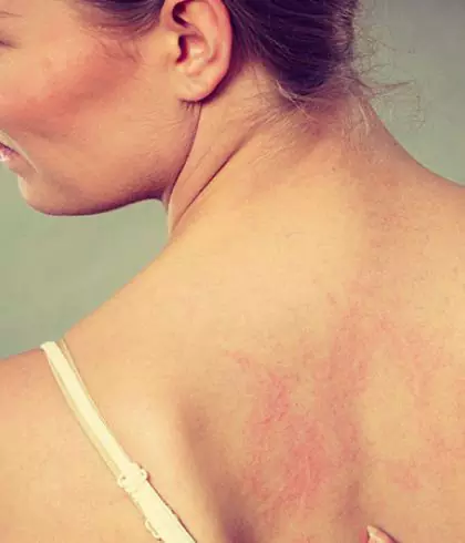 How to treat and get rid of hives