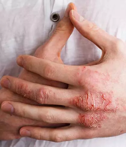 Psoriasis makes me feel hopeless