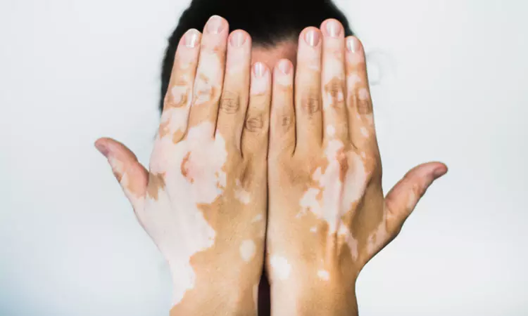 Psychological impact of Vitiligo