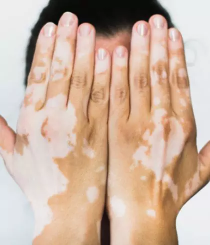 Psychological impact of Vitiligo