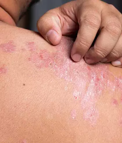 SCOPE OF HOMEOPATHY IN TREATING PSORIASIS!