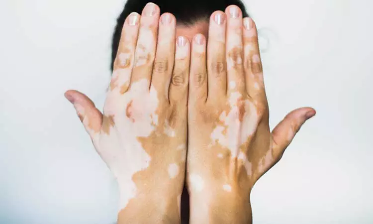 Vitiligo is more than just a skin disorder