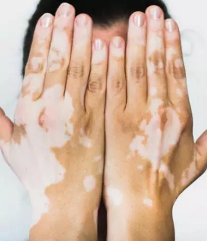 Vitiligo is more than just a skin disorder