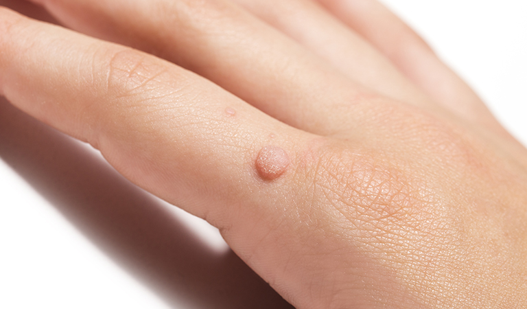 The Most Frequently Asked Questions on Wart Removal