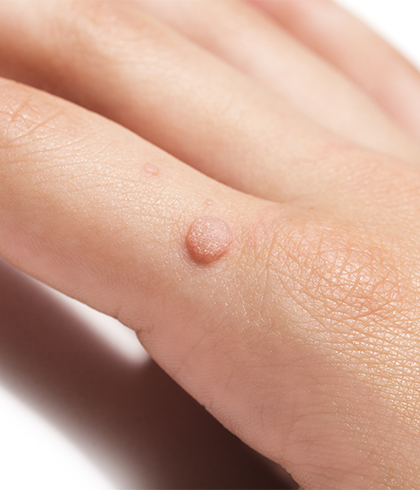 The Most Frequently Asked Questions on Wart Removal