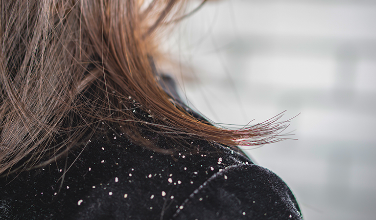 Understanding Dandruff & How to get rid of it Naturally