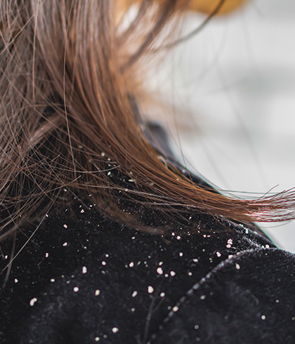 Understanding Dandruff & How to get rid of it Naturally