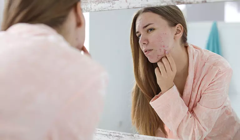 How to treat cystic acne with homeopathy?