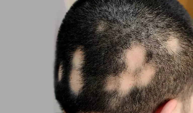 How to stop alopecia areata from spreading naturally