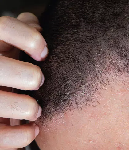 What is The Best Treatment for Scalp Eczema?