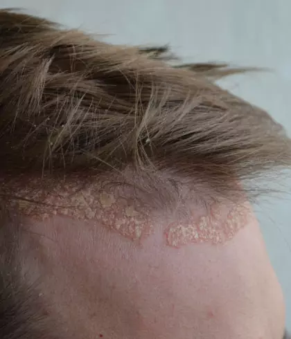 Can Scalp Psoriasis Cause Hair Loss?