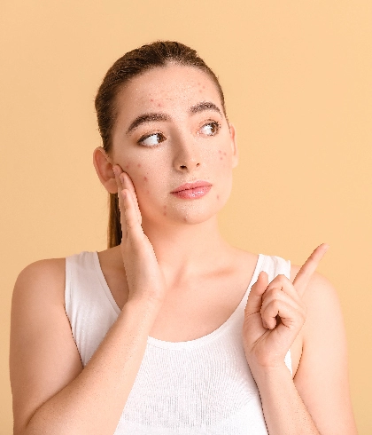 A SPOT OF TROUBLE: Homeopathy Alleviates Acne