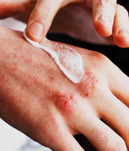 The Most Effective Home Remedies and Prevention Tips for Eczema